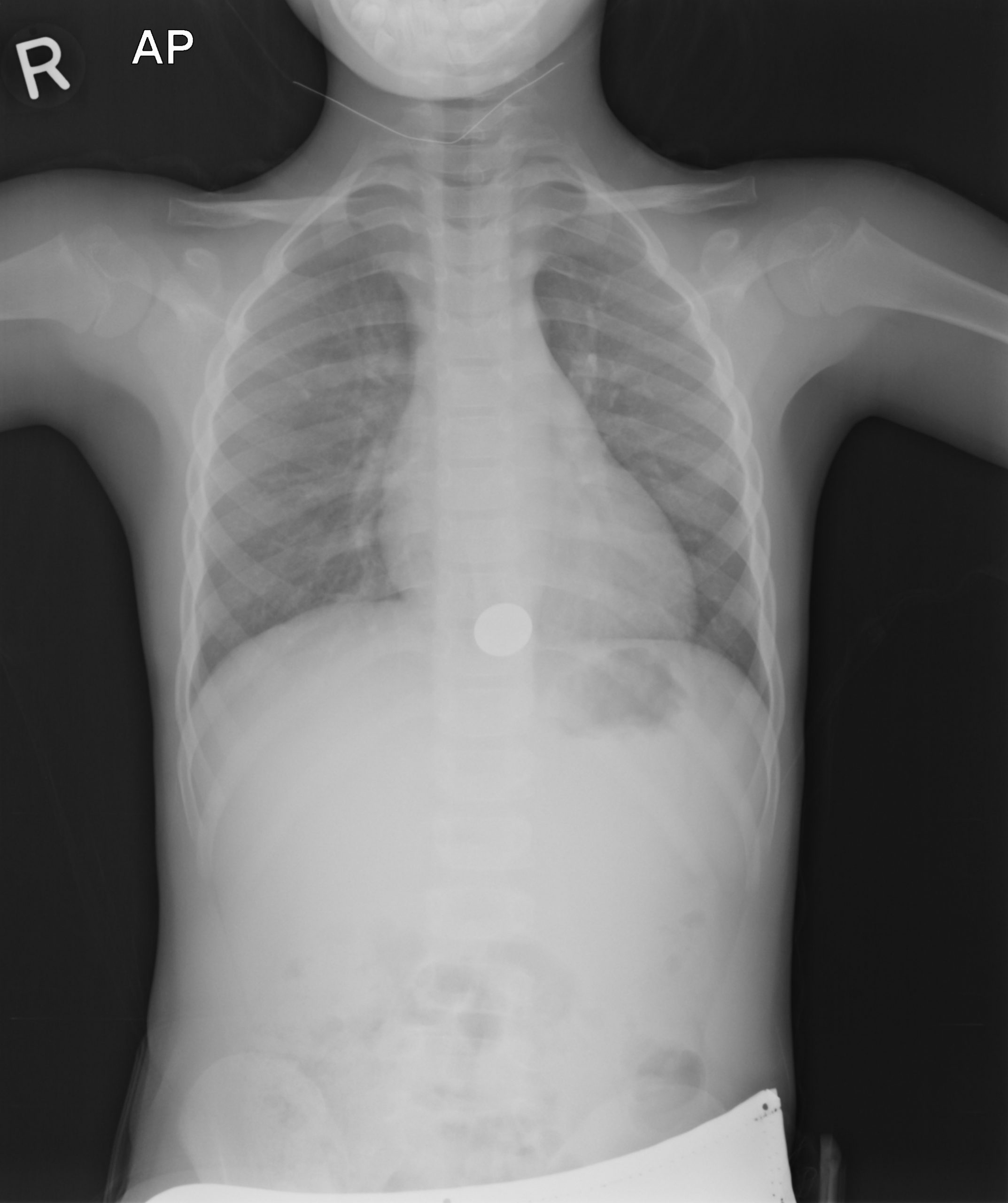 black and white x-ray image of a human torso with bones and organs visible; 