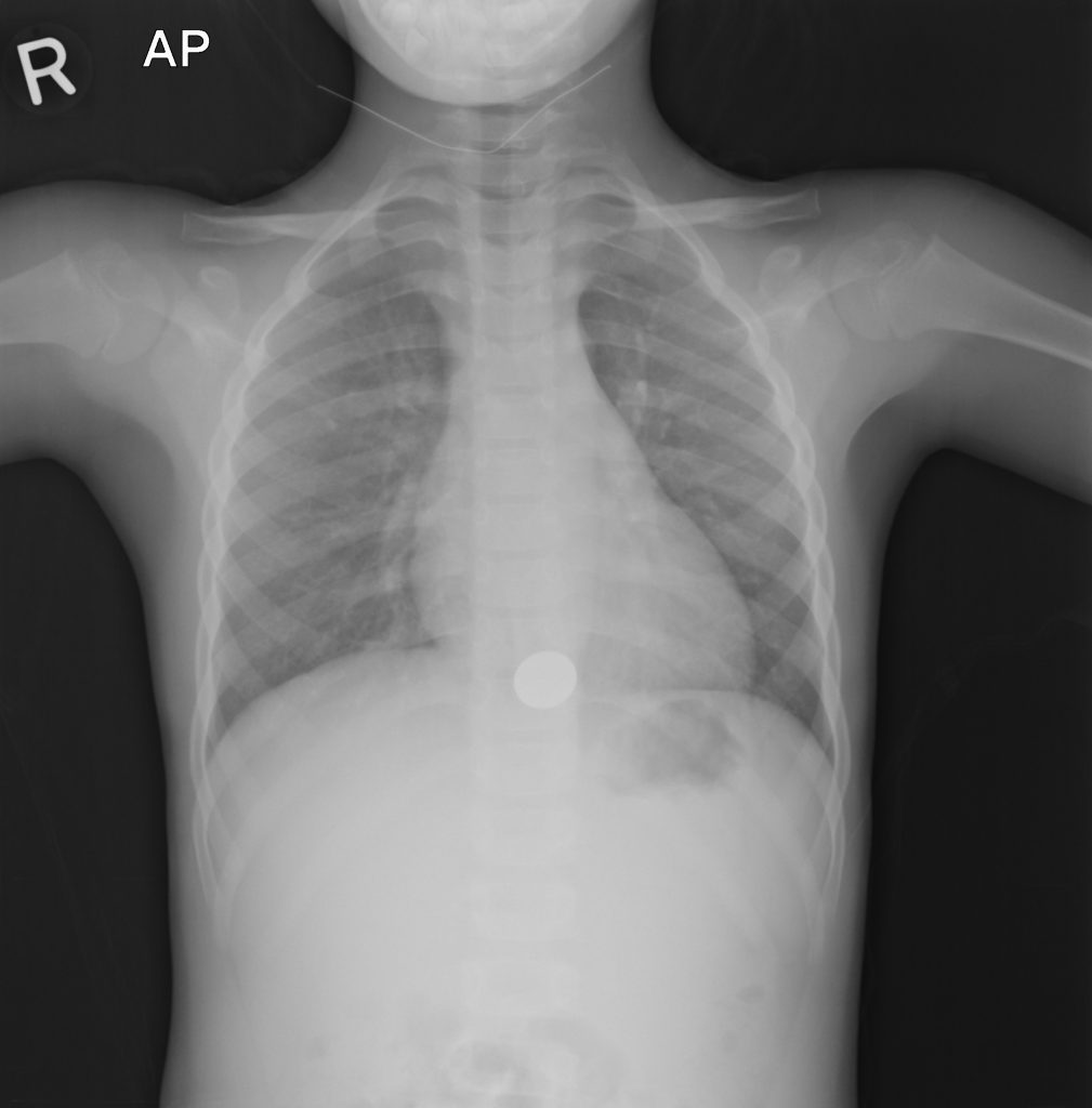 black and white x-ray image of a human torso with bones and organs visible; "R AP" appears in spaced out capital letters in the upper left corner